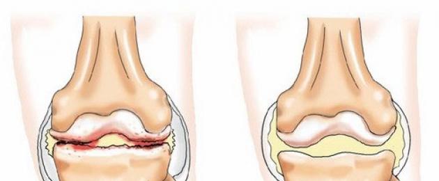 Болит колено с внутренней стороны – что делать? Как лечить больное колено, если локализация боли сбоку с внутренней стороны. Из-за чего появляется боль с внутренней стороны сбоку колена и как от нее избавиться