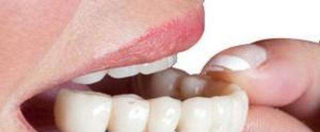 Возможные варианты протезирования при полном отсутствии зубов. Протезирование при отсутствии большого количества зубов: выбираем лучшие протезы при частичной или полной адентии Протезирование зубов при их отсутствии