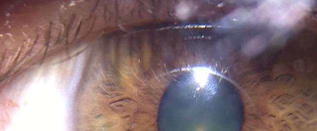 Периокулярная гемангиома (капиллярная гемангиома глаза) новорожденного ребенка. Лечение гемангиом глаз Кавернозная гемангиома под глазиком у ребенка причина