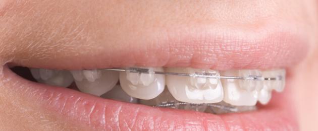 Как брекет система исправляет зубы. Что такое брекеты и как они работают? Виды