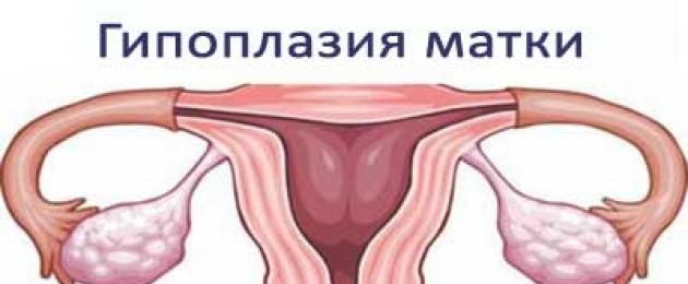 Гипоплазия матки причины и лечение. Гипоплазия матки: можно ли забеременеть с такой патологией? Лечение гипоплазии гормональными препаратами и народными средствами