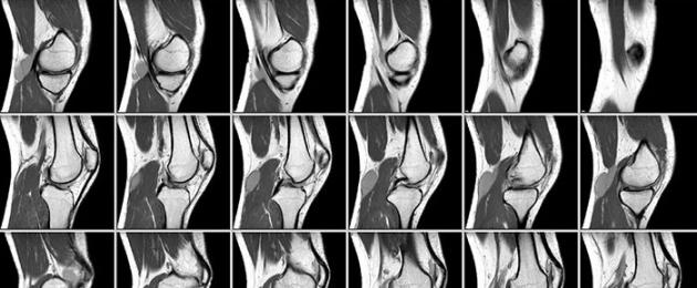 МРТ-исследование суставов: показания к применению и цена процедуры. МРТ коленного сустава: что показывает, как проводится, показания Томография связок