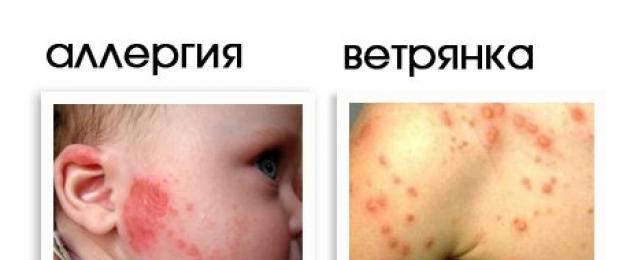 Поллиноз у детей: аллергия на пыльцу. Аллергия на лице, животе и теле у грудничка: лечение. Симптомы у грудничка на аллергию пищевую, на пыльцу, стиральный порошок, холод, солнце, контактную.