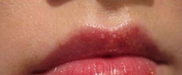 Punti sulle labbra sotto forma di semolino.  Cosa fare se compaiono punti bianchi sulle labbra
