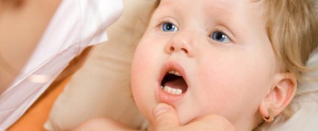 Молочница у детей во рту: причины, симптомы и лечение. Насколько опасна для детей молочница и как от нее избавиться