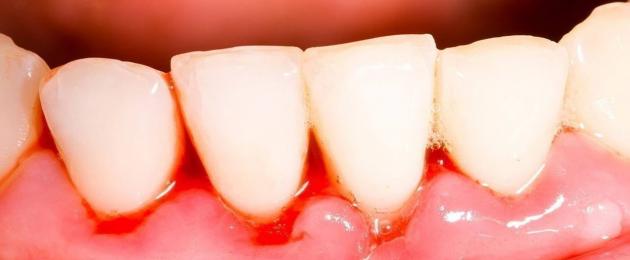 Причины и методы снятия воспаления десны около зуба. Воспаление десен и их лечение