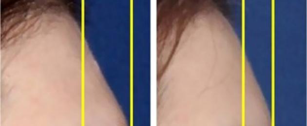 Внешний вид до и после процедуры проведения фронтопластики. Кому и когда нужно делать фронтопластику лба, отзывы косметологов и пациентов