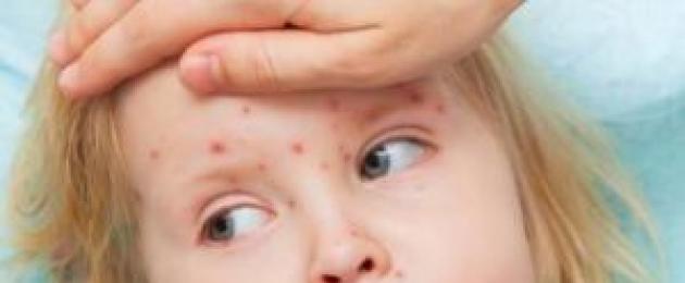 Прививка от кори ребенку в год реакция. Прививка от кори
