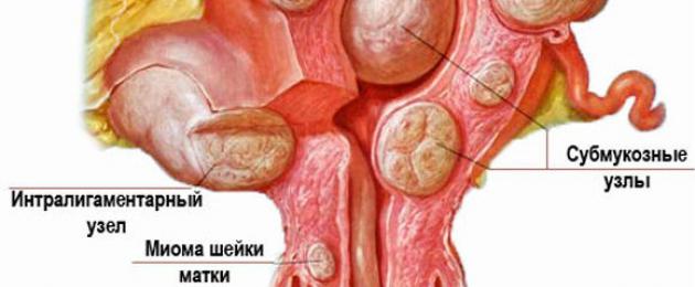 Fibromi: un tumore benigno dell'utero.  Mioma: tumore benigno dell'utero Leiomioma sottomucoso dell'utero trattamento