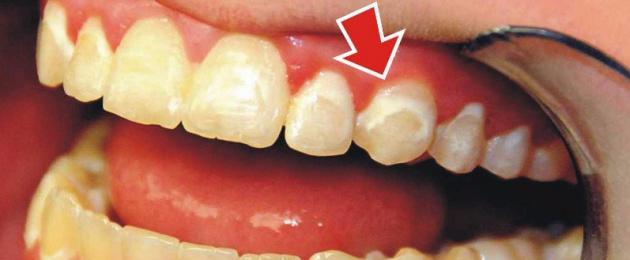 Удаление налета с зубов: цена и фото. Как и чем очистить зубы от налета в домашних условиях