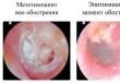 التهاب الأذن الوسطى الحاد رمز التصنيف الدولي للأمراض.  التهاب الأذن الوسطى الحاد.  العلاج الجراحي لالتهاب الأذن الوسطى الحاد