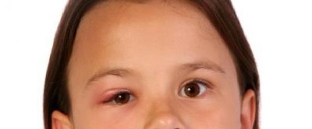 Лечение ячменя на глазу у детей — как правильно действовать? У ребенка на глазу ячмень, чем лечить, Комаровский что говорит. 