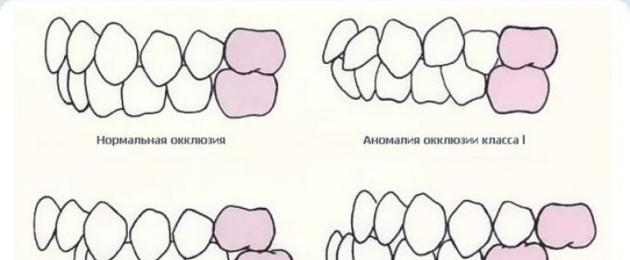 Виды окклюзий, их характеристика и признаки. Оценка окклюзионных и артикуляционных соотношений зубных рядов Окклюзия зубов что