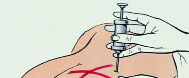 Как правильно делать укол в ногу? Как правильно сделать самому себе внутримышечную инъекцию в бедро. 