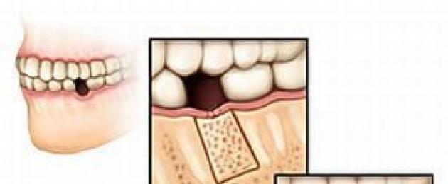 Restauro e crescita del tessuto osseo.  Metodi per aumentare il tessuto osseo durante l'impianto dentale - rigenerazione in caso di atrofia ossea