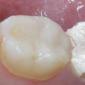 Cosa fare se un dente fa male con un'otturazione temporanea C'è un'otturazione temporanea e il dente fa male