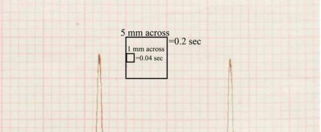 1 elettrocardiografia.  Decodifica dell'ECG