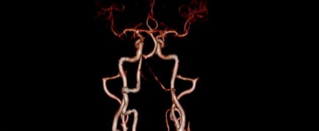 Синдром позвоночной артерии. Сужение просвета правой позвоночной артерии