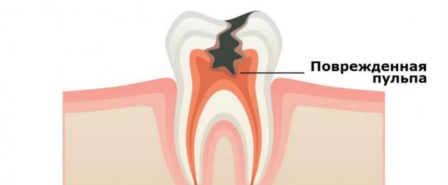 Лечить зуб с удалением нерва. Депульпация зуба: показания и этапы процедуры
