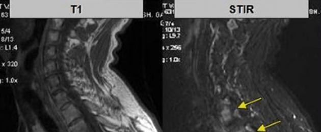 Modalità di agitazione delle articolazioni sacroiliache della risonanza magnetica.  TAC dell'articolazione sacroiliaca: vantaggi, controindicazioni, tecnica e costi