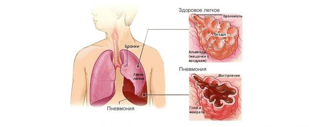 I primi segni di polmonite.  Cause di ascesso e cancrena dopo la polmonite