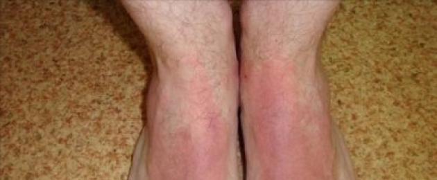 Дерматит на ступнях ног. Механизм проявления сенсибилизации и поражений кожи. Положительное влияние диеты