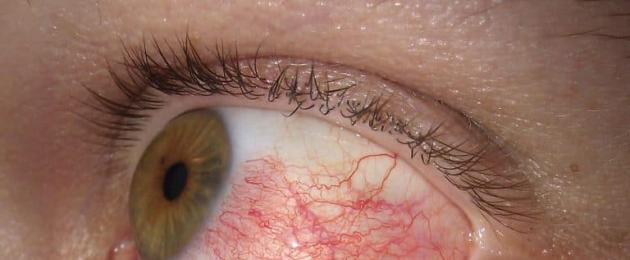 Гиперемия глаз: причины и лечение. Покраснение глаз: основные причины