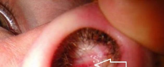 Болячка под носом у ребенка чем мазать. Как можно помочь больному? Особенности лечения болячек в носу