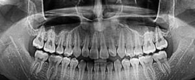 لماذا تؤلم الأسنان الأمامية السفلية والعلوية؟  لماذا تؤلم الأسنان وتؤذيها: الأسباب وطرق العلاج والوقاية من ألم الأسنان