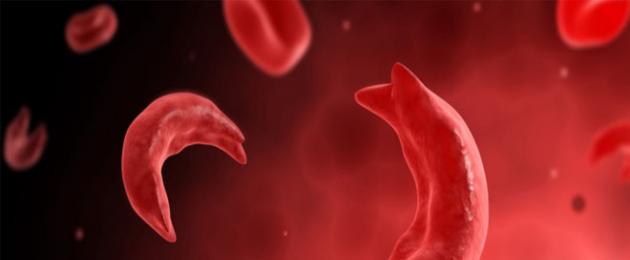 Причиной серповидноклеточной анемии является. Серповидноклеточная анемия: развитие, симптомы, лечение, прогноз