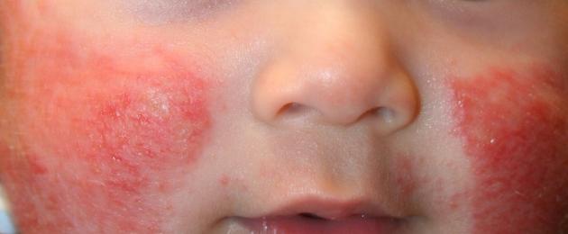 Come trattare le allergie cutanee negli adulti e nei bambini: un approccio integrato.  Vanno evidenziati i principali.  Preparati ormonali per allergie e prurito.
