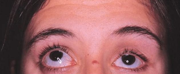 Cos'è l'enoftalmo del bulbo oculare.  Una malattia separata o un sintomo di un altro disturbo: la definizione di enoftalmo e i metodi di trattamento Sospetto l'enoftalmo dove controllare