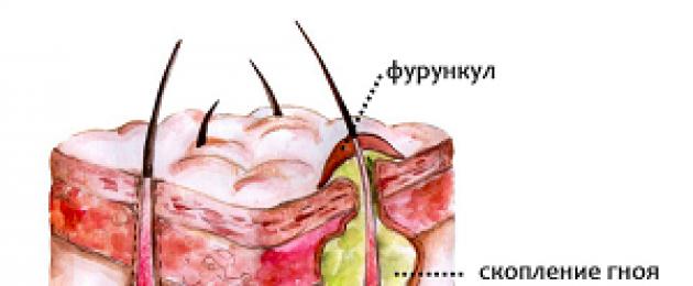 Чирей или фурункул на половых губах: фото, лечение. Симптомы и лечение фурункула на губе