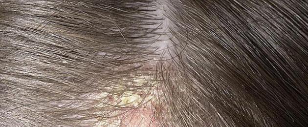 Блестит кожа головы у женщины. Тревожный симптом! Если болит кожа головы и выпадают волосы: какие средства и процедуры помогут? К самым распространенным препаратам относят