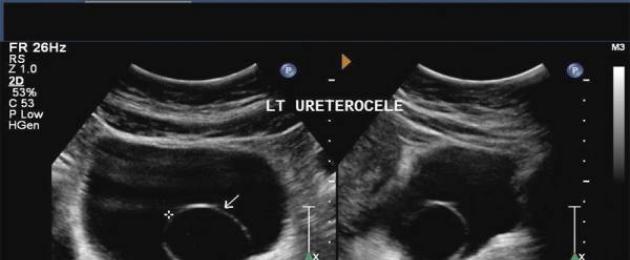 Dissezione endoscopica dell'ureterocele.  Cause, sintomi e trattamento dell'ureterocele nelle donne