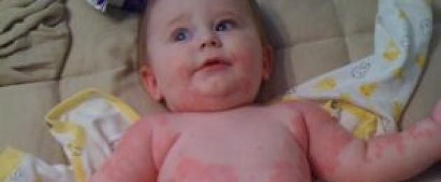 Несколько красных пятен на теле ребенка. Зуд и покраснение кожи на теле ребенка в виде пятен: симптомы аллергии и других заболеваний, методы лечения