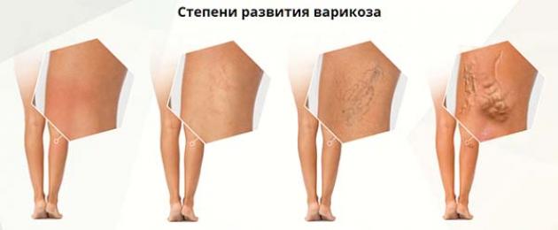 Il grave gonfiore delle gambe è un rimedio popolare.  Rispetto del programma di lavoro e riposo