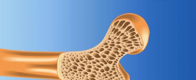 Что такое остеопороз. Симптомы и лечение остеопороза