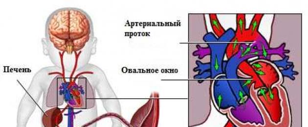 Forame ovale aperto nel cuore: cause, sintomi, trattamento e prognosi.  Forame ovale pervio