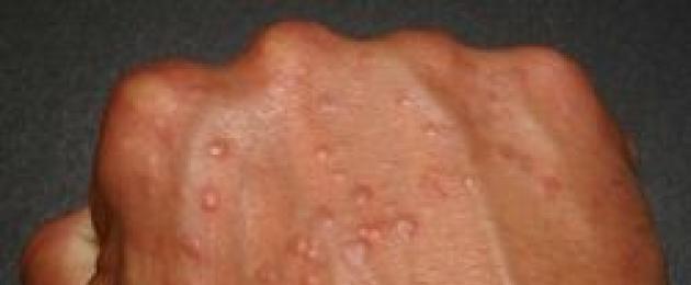 Бордовая, красноватая или розовая болячка на коже, которая иногда шелушится или болит. Язвы на теле лечение