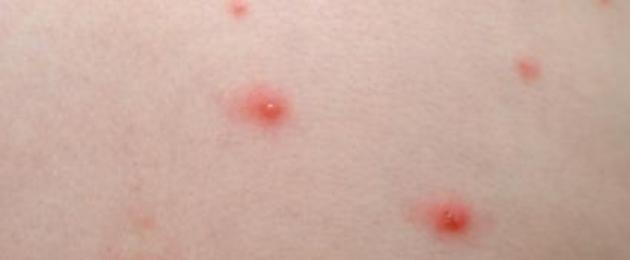 Красные точки на теле кровоточат чем опасны. Красные точки на теле и печень