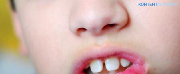 يعاني الطفل من التهاب الفم لمدة شهرين.  علاجات التهاب الفم عند الأطفال - آمنة وفعالة