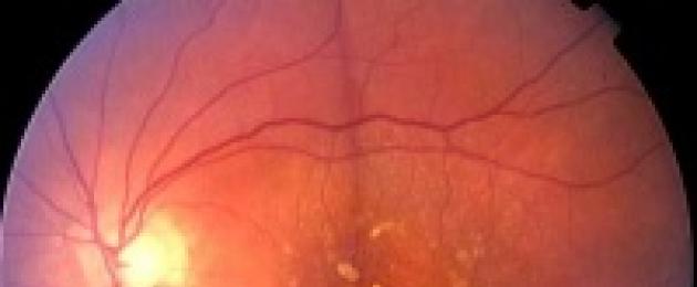 Сетчатка глаза: строение и функции, основные патологии. Диагностика организма по сетчатке глаза Франшиза определения заболевания по сетчатке глаза