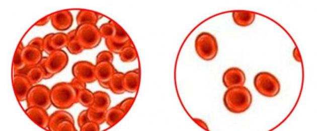 Malattie del sangue e del sistema emopoietico.  Sindromi con danno al sistema emopoietico