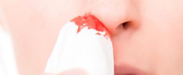 Sito più comune per il sangue dal naso.  Quali malattie causano il sangue dal naso?
