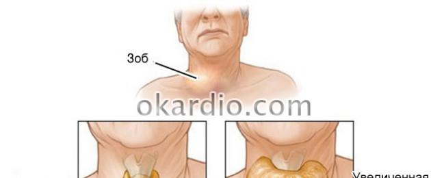 Легкая дисциркуляция по позвоночным артериям и венам. Нарушение венозного оттока: причины, симптомы