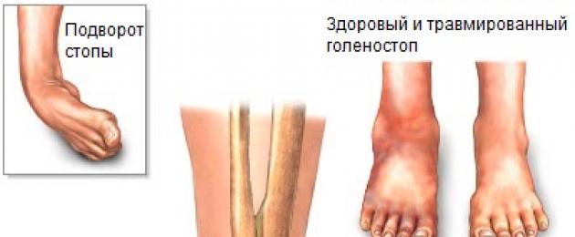 Sintomi e trattamento della distorsione della caviglia.  Manifestazioni e trattamento della distorsione della caviglia