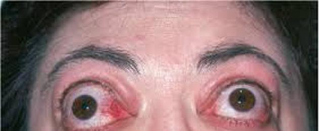 Односторонний пульсирующий экзофтальм является признаком. Увеличение глаза и пучеглазость — экзофтальм