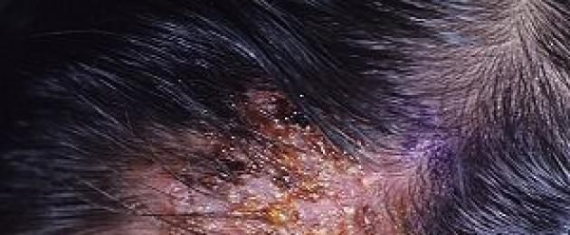 Trattamento dell'herpes sotto i capelli.  La manifestazione e il trattamento dell'herpes sul cuoio capelluto