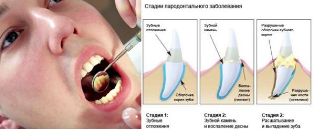 Склерозирующая терапия в стоматологии. Хронический гипертрофический гингивит: клиническая картина, диагностика, лечение